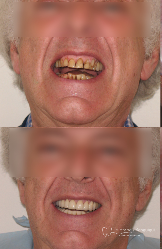avant-apres-patient-restauration-dentaire