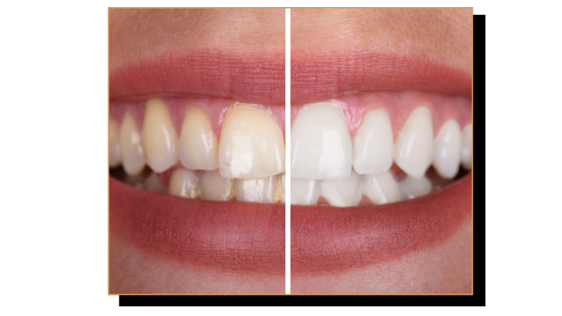 blanchiment-dentaire-comparaison-avant-apres