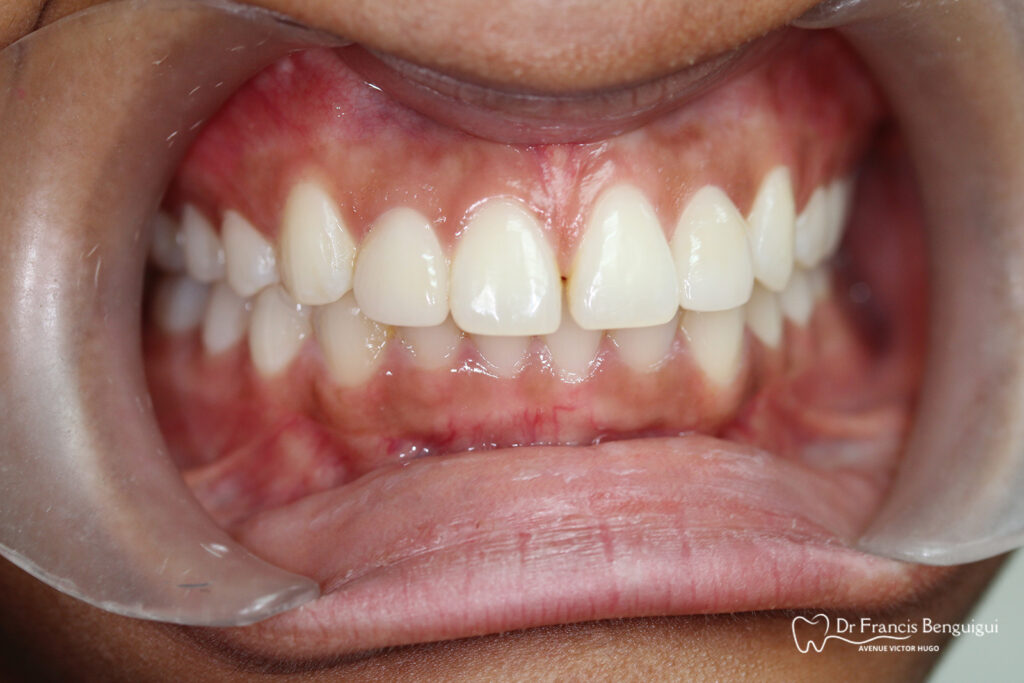 Après facette dentaire incisive latérale supérieure zoom bouche