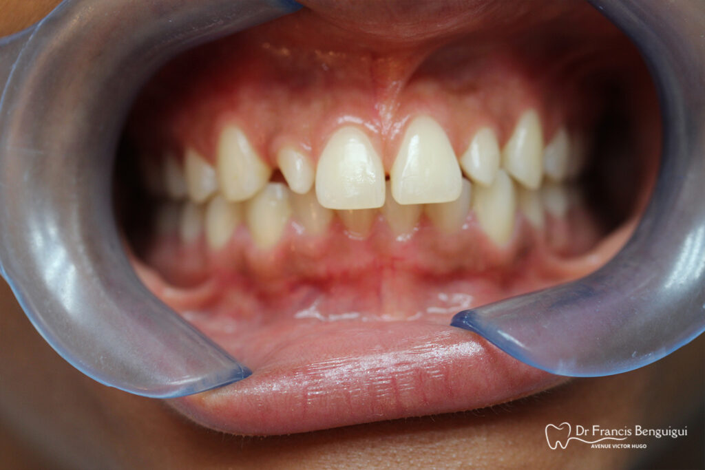 Avant facette dentaire incisive latérale supérieure zoom bouche