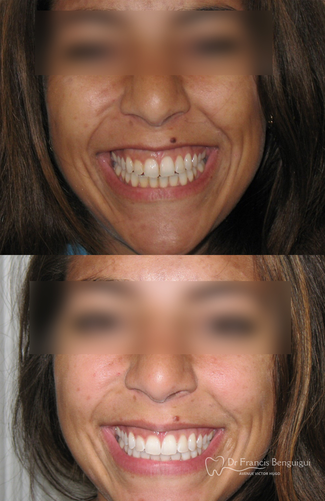 femme-patient-avant-apres-blanchiment-dentaire