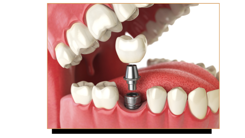 implant-dentaire-schema