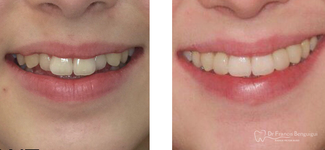 orthodontie-alignement-dentaire-avant-apres