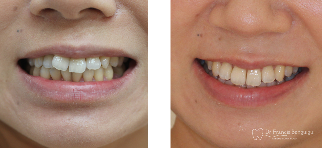 orthodontie-alignement-dentaire-invasilign-paris