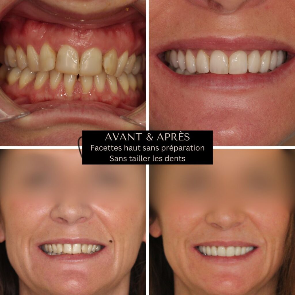 transformation sourire facette dentaire femme haut