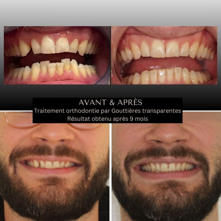 benguigui-orthodontie-traitement-9-mois