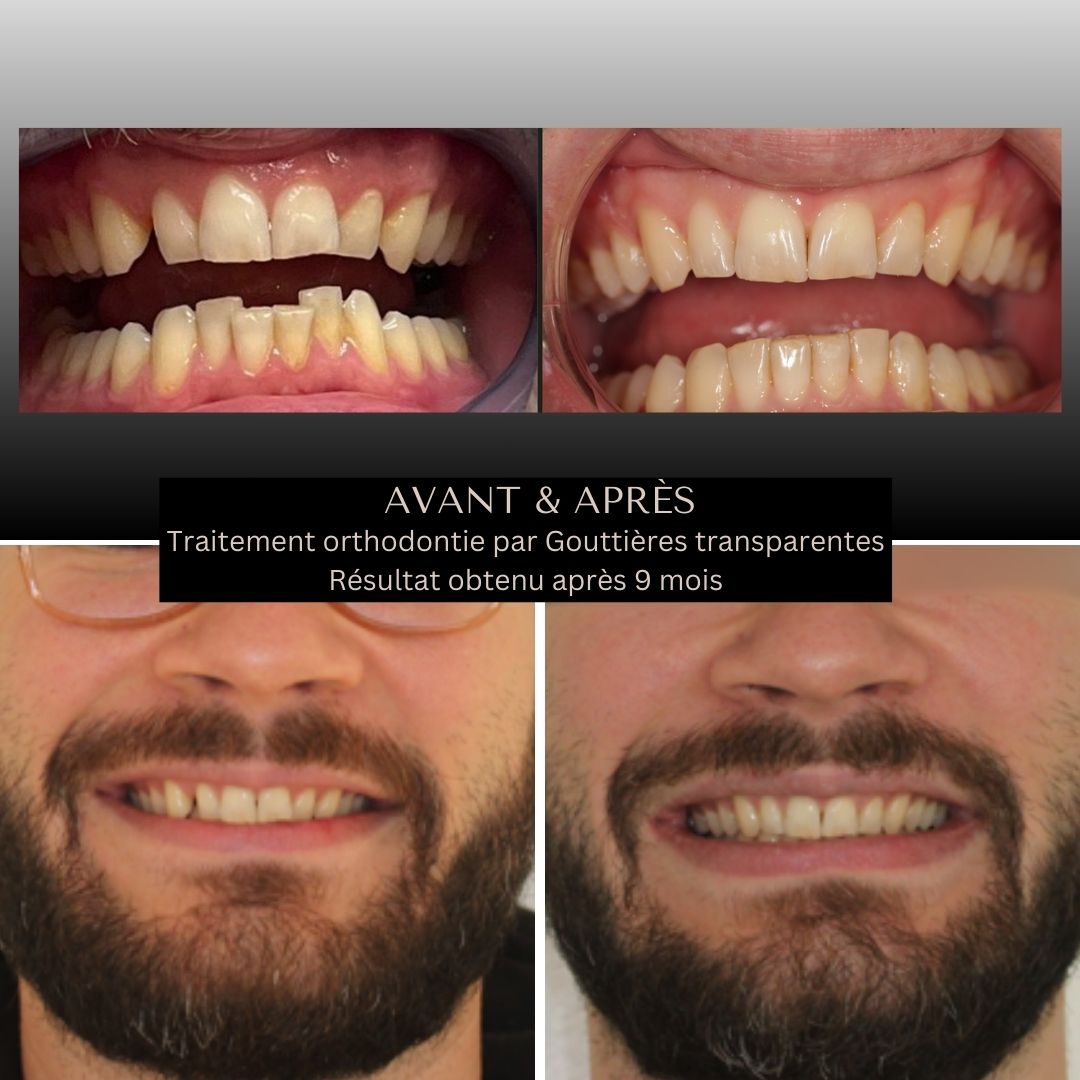 benguigui-orthodontie-traitement-9-mois